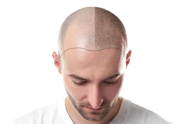 Man before and after hair loss treatment on white background